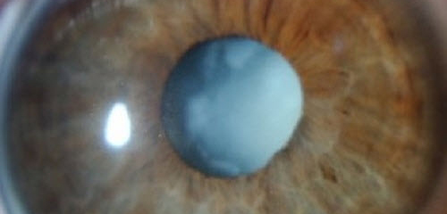 Eye surgeon in Nottingham Dr. Dalia G. Said. Phacoemulsification of the Lens with Implant.