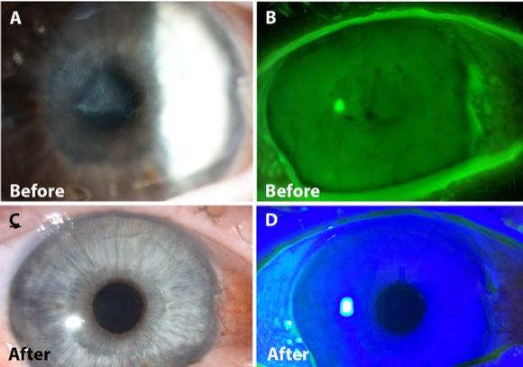 Alcohol Delamination of Corneal Epithelium. Eye surgeon in Nottingham.