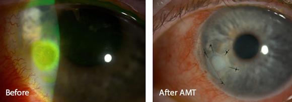 Amniotic Membrane Transplant to Cornea. Eye surgeon in Nottingham.