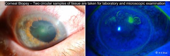 Corneal Biopsy, Corneal Scrapes. Eye surgeon in Nottingham.