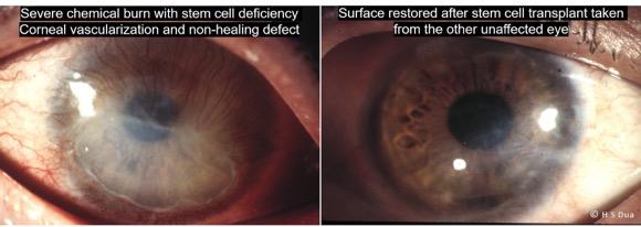 Limbal (Stem Cell) Transplantation 1. Eye surgeon in Nottingham.