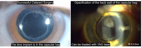 YAG laser. Eye surgeon in Nottingham.