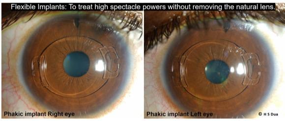 Phakic Implants. Eye surgeon in Nottingham