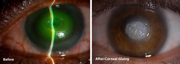 Corneal Gluing.Eye surgeon in Nottingham.