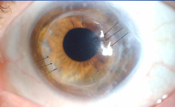 Arcuate Incisions and Compression Sutures. Eye surgeon in Nottingham.