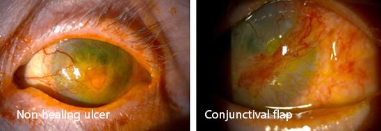 Conjunctival Hooding and Free Conjunctival Auto Grafts. Eye surgeon in Nottingham.