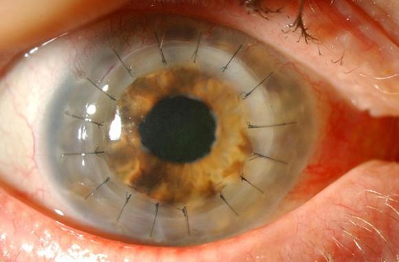 Corneal Transplants. Eye surgeon in Nottingham.
