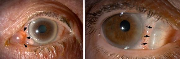 Excision of Lesions. Eye surgeon in Nottingham.