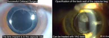 Eye surgeon in Nottingham. Lens Capsular Opacification Treatment.