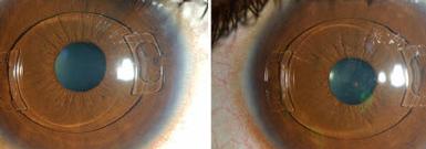 Eye surgeon in Nottingham. Refractive Lens Surgery Treatment.