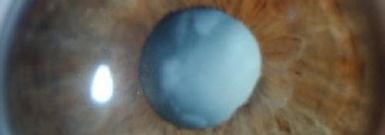 Eye surgeon in Nottingham. Cataract treatments.