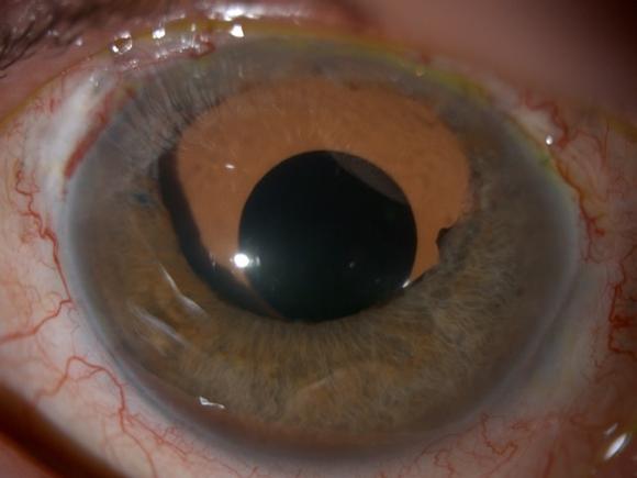 Aniridia Lens Implant. Eye surgeon in Nottingham.