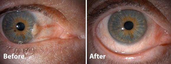 Excision of Pinguecula and Pterygium with Autologous Conjunctival Graft. Eye surgeon in Nottingham.