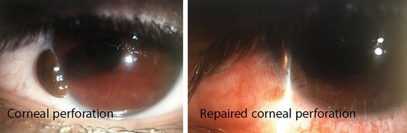 Repair of Lacerations. Eye surgeon in Nottingham.